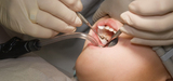 Amalgames dentaires : polmique autour de l'utilisation de mercure