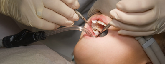 Amalgames dentaires : polémique autour de l'utilisation de mercure